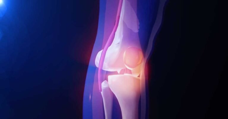 Painless Lump on Knee